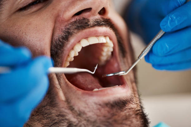 Best Emergency Dental Care for Broken or Chipped Teeth in Le Claire, IA
